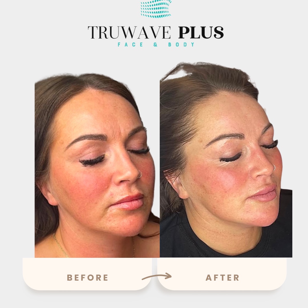 Face EMS Before and After